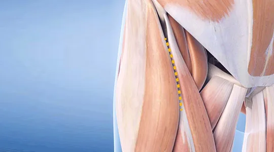 Direkter anteriorer Hüftzugang APPROCCIO ANTERIORE DIRETTO 540x300 1