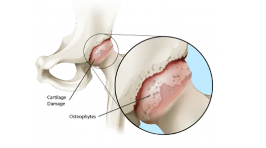 Hüfte Arthritic hip 4