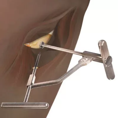 Primäre Hüftgelenksysteme Changes 12 1 1