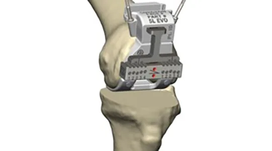 PROPHECY® PERSONALISIERTE KNIELÖSUNGEN Prophecy Gap Balancing 540x300 1