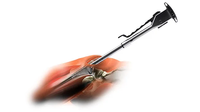 GEWEBESCHONENDE HÜFTOPERATIONEN Superpath approach portal 0 1